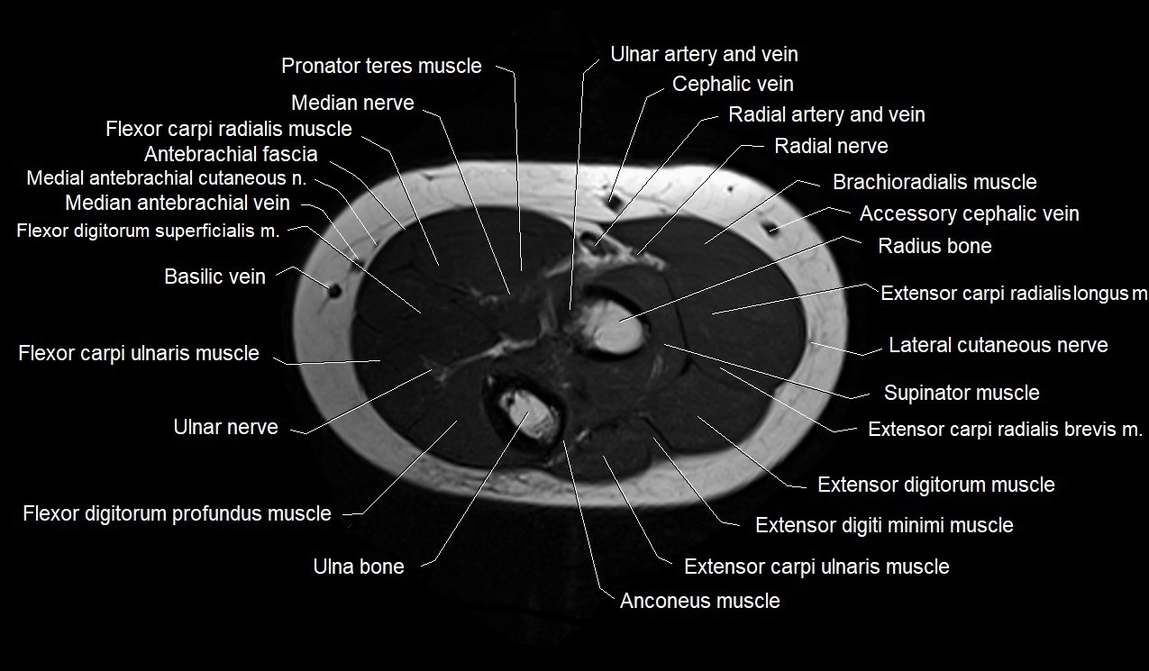 MRI 3T forearm axial cross sectional anatomy image 13.webp